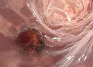 Kolorektal Kanseri Gençlerde Artışı Önleme Yolları: 3 Basit Tarif news-09082024-063754