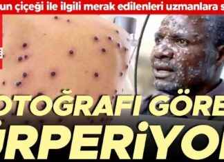 Maymun Çiçeği Nedir ve Nasıl Tedavi Edilir? – Uzmanlar Hürriyet’e Açıkladı news-17082024-083743